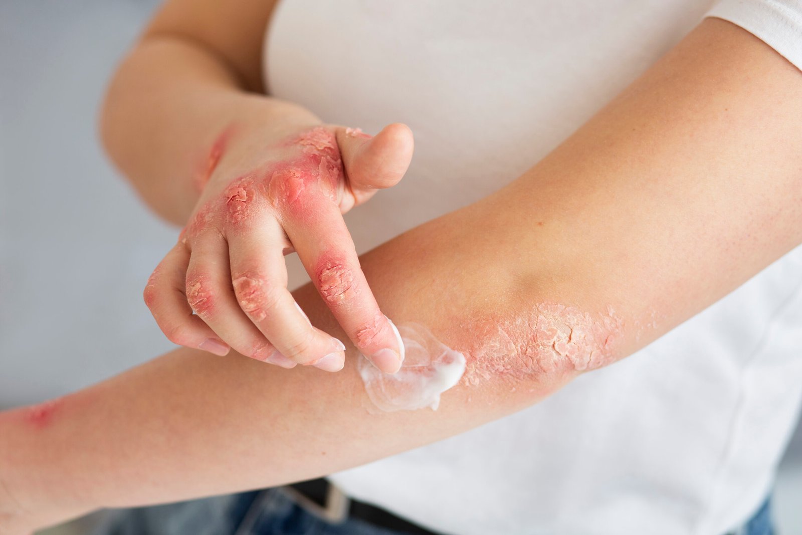 Breaking Down Psoriasis Myths: Empowering Understanding with MediDocs